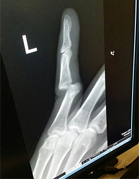 Dislocated finger